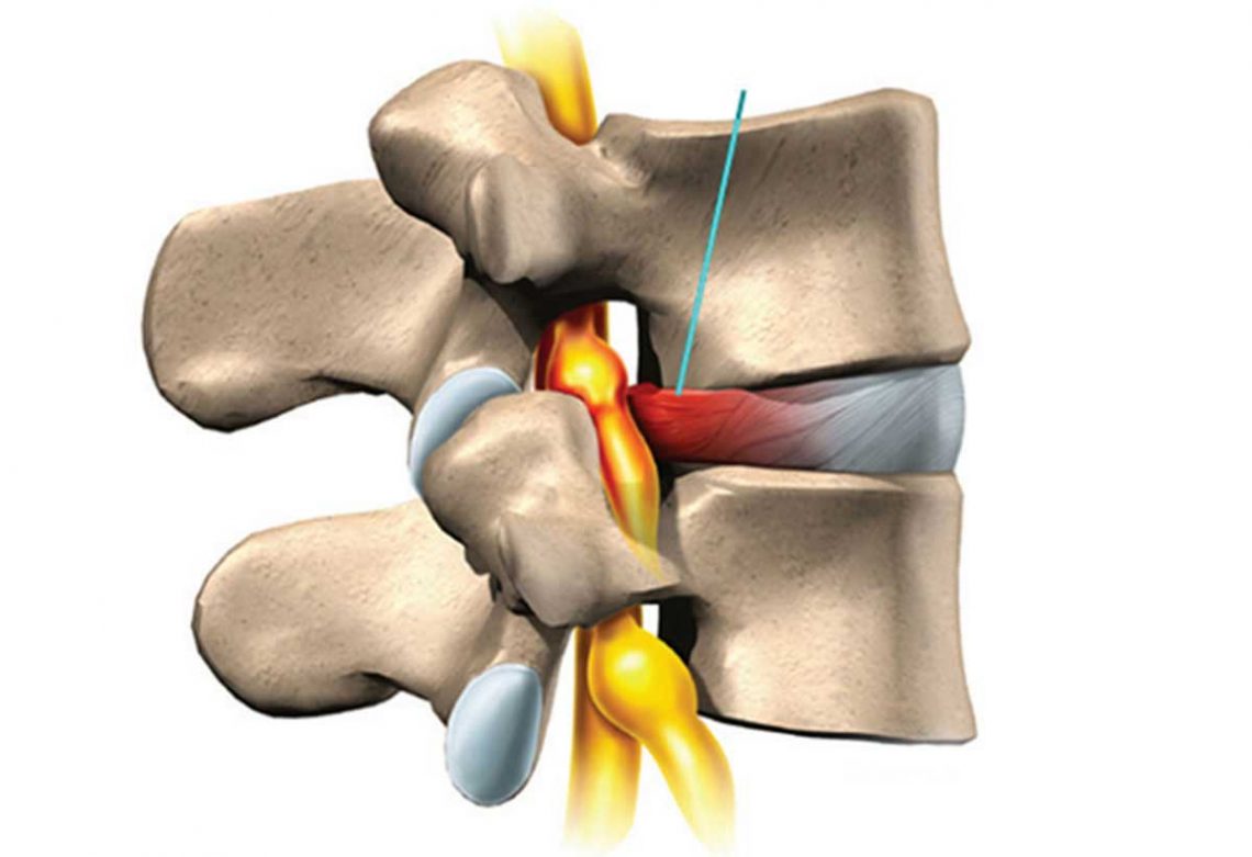 Lumbar Disc Prolapse 