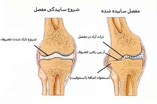 Osteoarthritis cell therapy