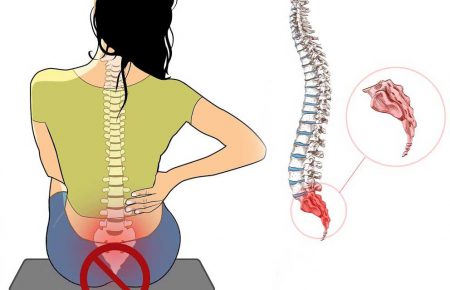 درد دنبالچه یا COCCYDYNIA
