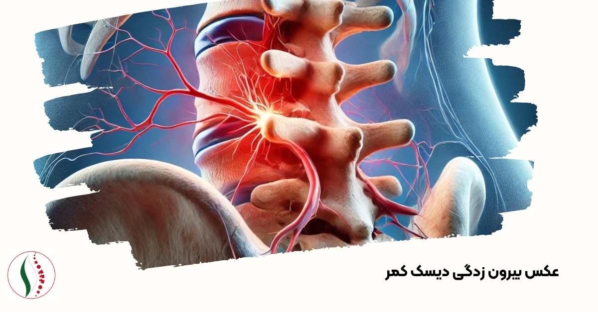 عکس بیرون زدگی دیسک کمر 