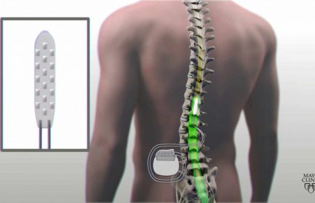Spinal Cord Stimulator محفزات العمود الفقری