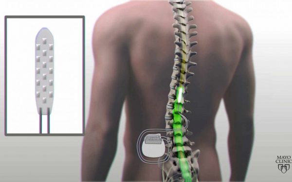 Spinal Cord Stimulator محفزات العمود الفقری