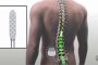 Spinal Cord Stimulator محفزات العمود الفقری