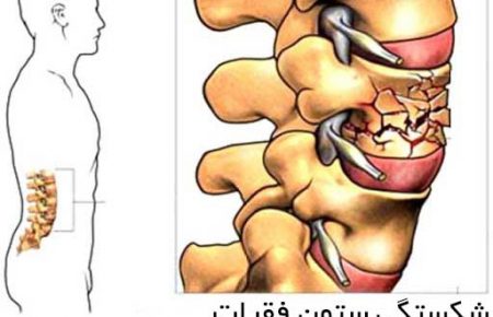 شکستگی ستون فقرات