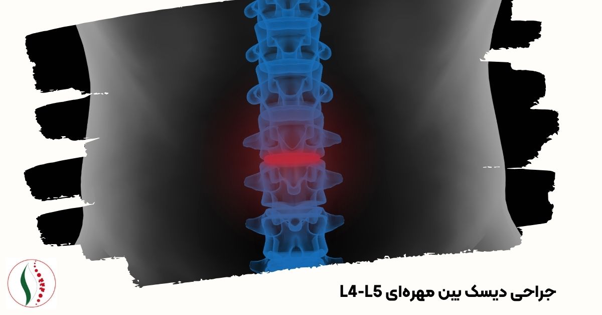 جراحی دیسک بین مهره‌ای L4-L5