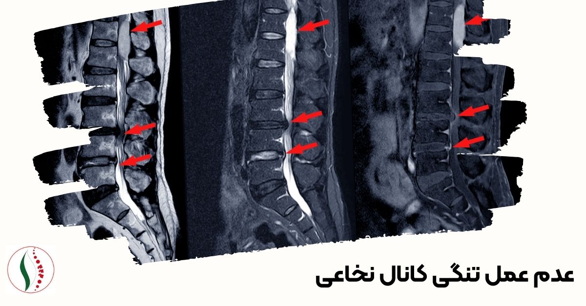 عدم عمل تنگی کانال نخاعی