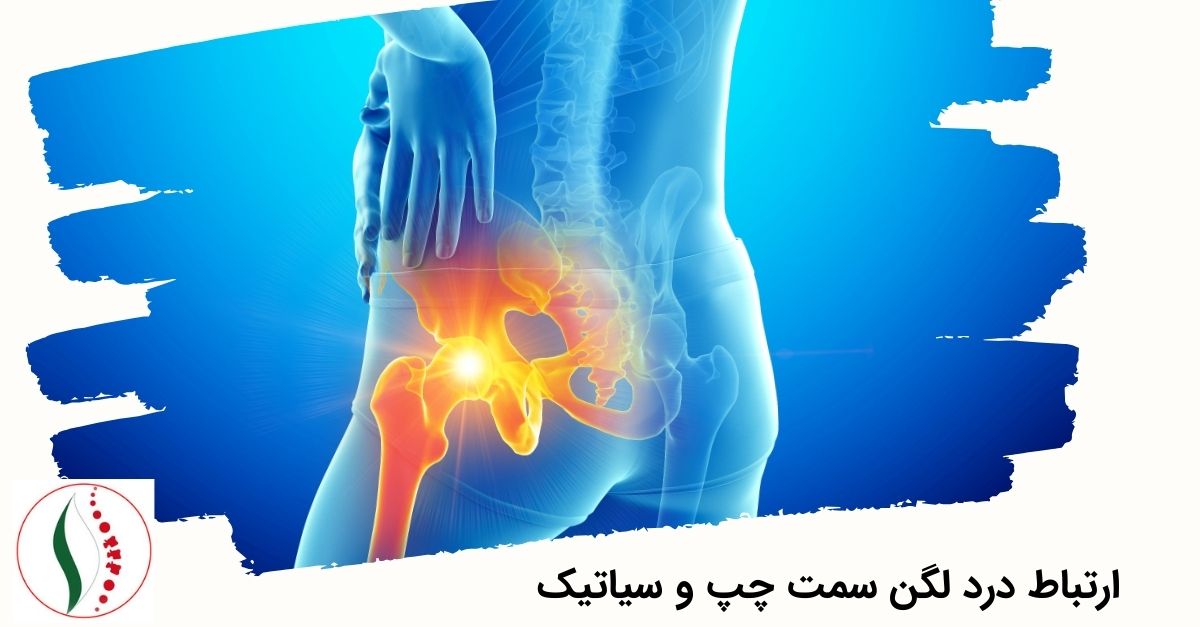 ارتباط درد لگن سمت چپ و سیاتیک