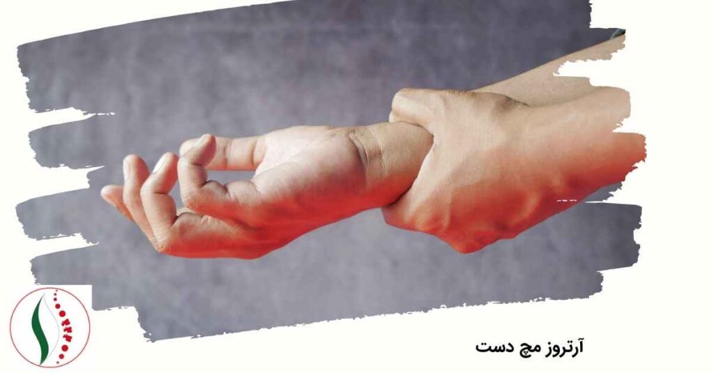 آرتروز مچ دست