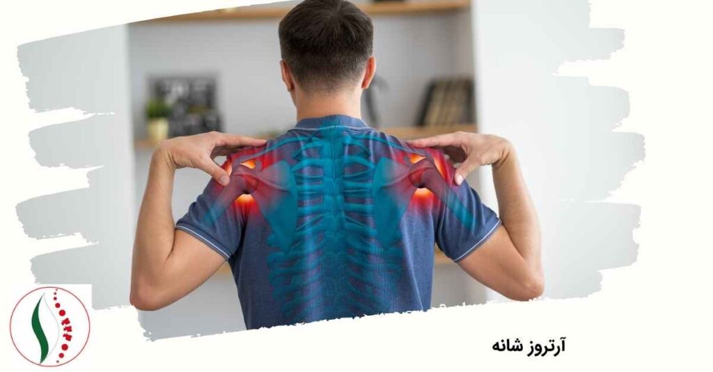 آرتروز شانه