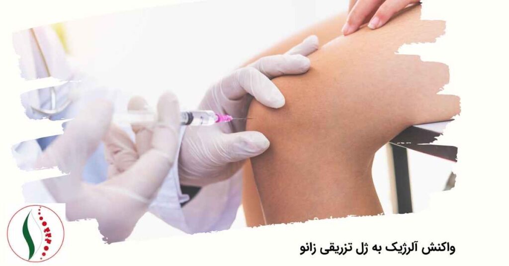 واکنش آلرژیک به ژل تزریقی زانو