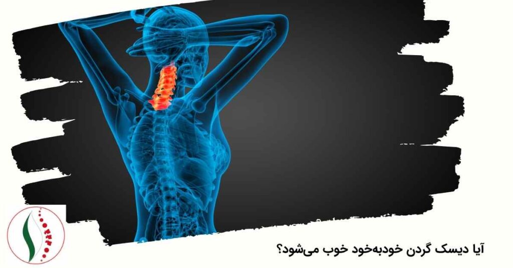 آیا دیسک گردن خودبه‌خود خوب می‌شود؟
