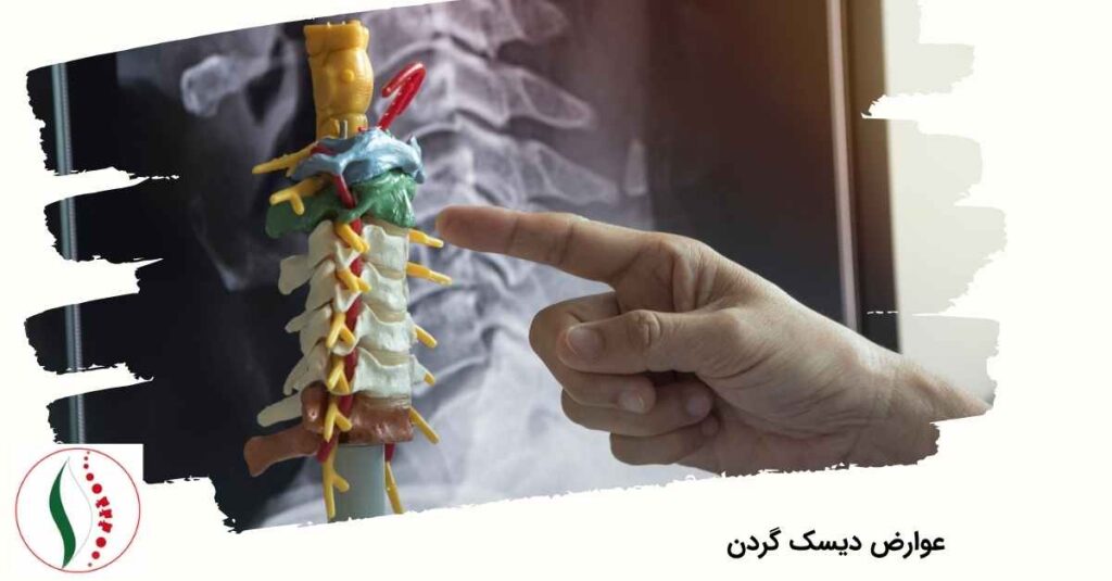 عوارض دیسک گردن