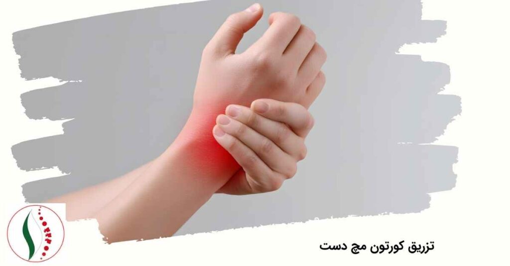 تزریق کورتون مچ دست