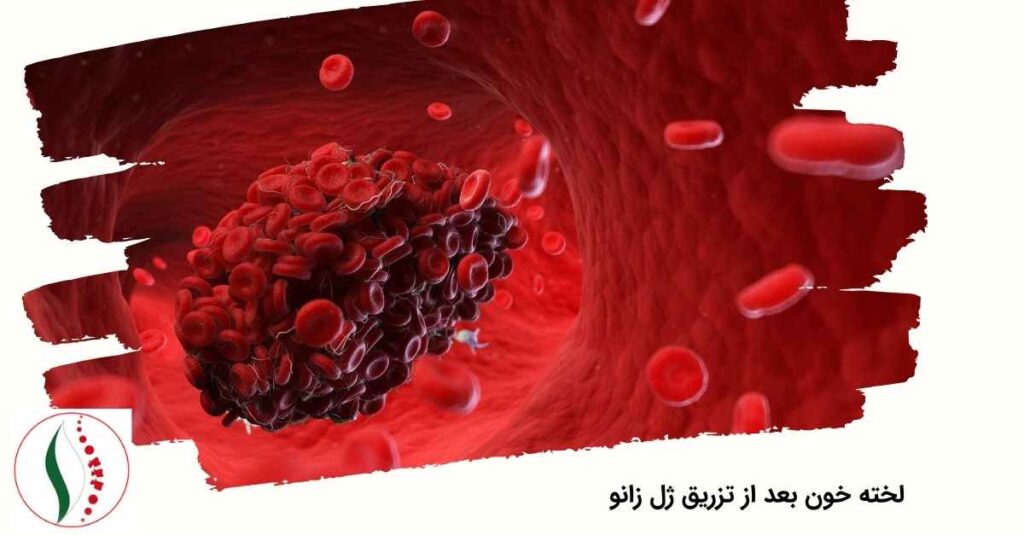 لخته خون بعد از تزریق ژل زانو