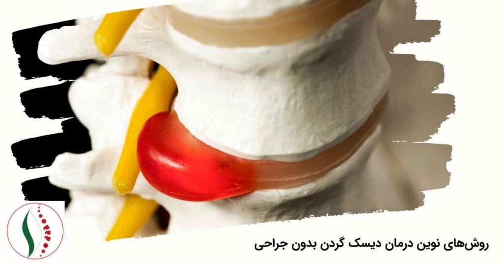 روش‌های نوین درمان دیسک گردن بدون جراحی