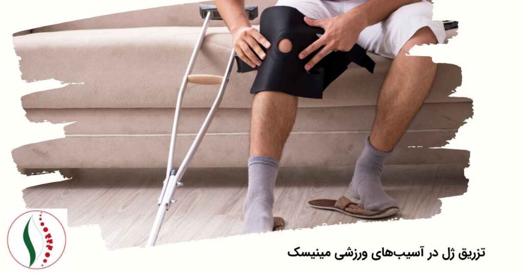 تزریق ژل در آسیب‌های ورزشی مینیسک