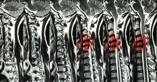 آیا دیسک گردن خودبهخود خوب میشود؟