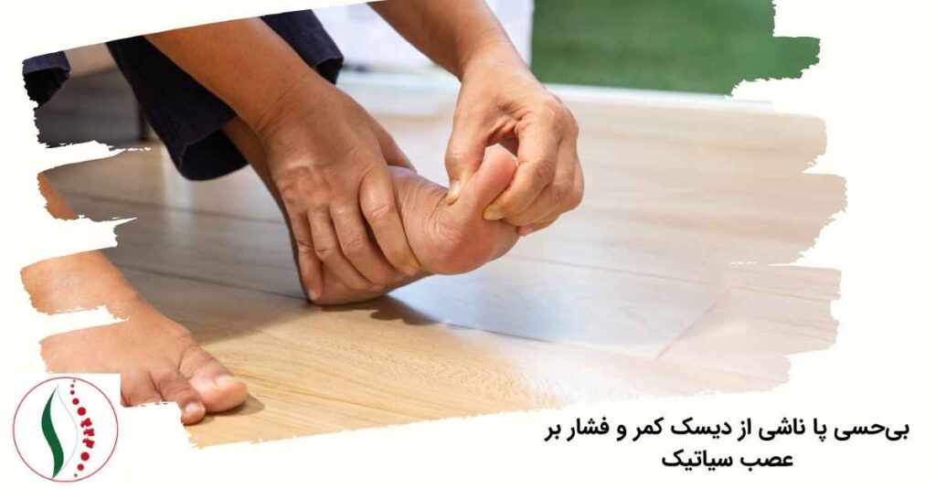 بی‌حسی پا ناشی از دیسک کمر