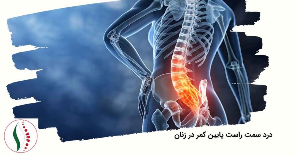 درد سمت راست پایین کمر در زنان