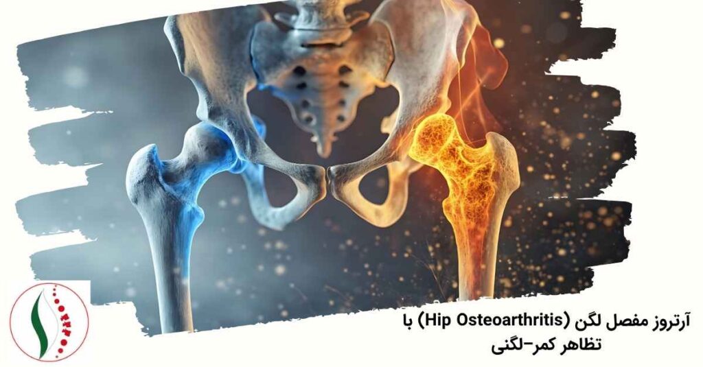 آرتروز مفصل لگن