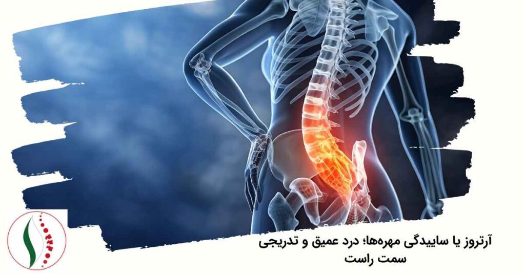 آرتروز یا ساییدگی مهره‌ها