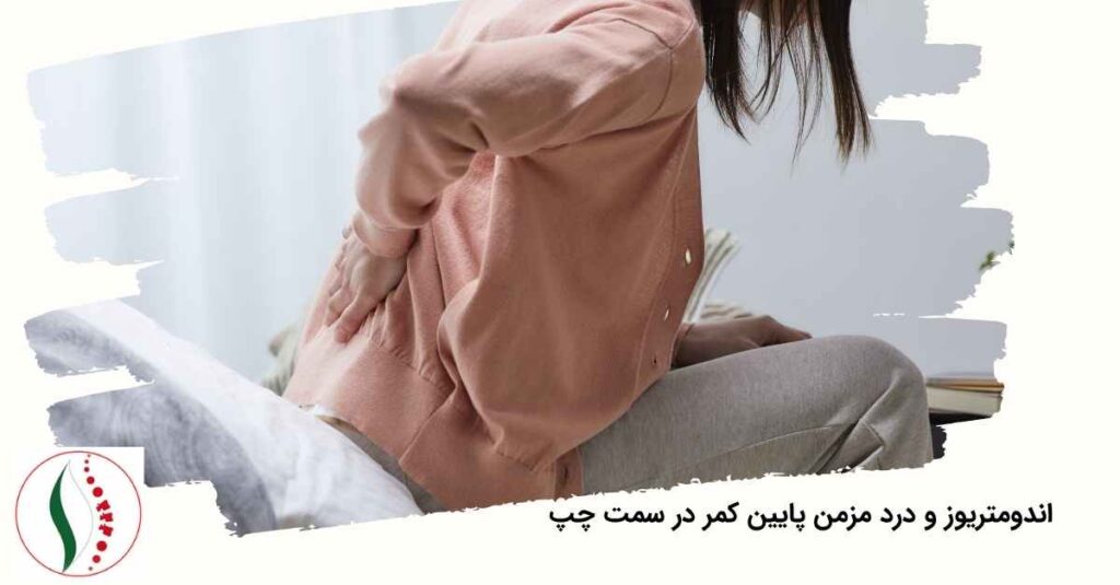 اندومتریوز و درد پایین کمر در سمت چپ