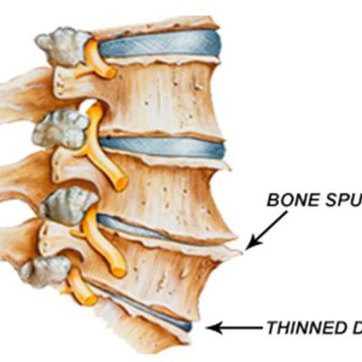 Spinal degenerative joints disease (Spondylosis)
