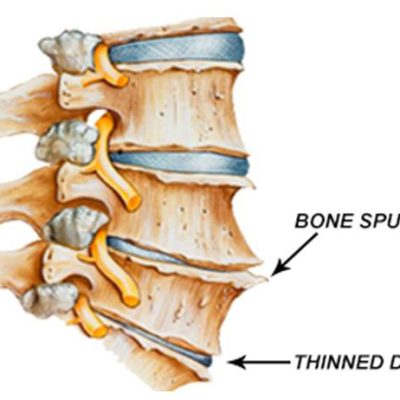 Spinal degenerative joints disease (Spondylosis)