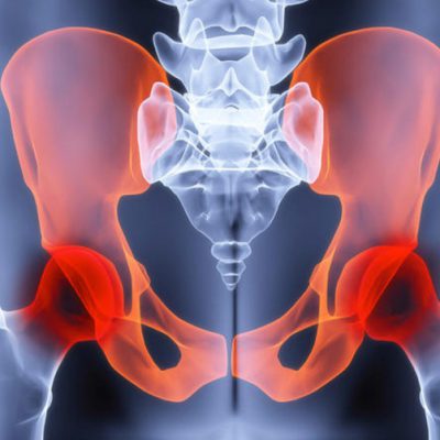Hip Osteoarthritis