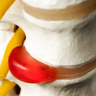 درمان دیسک کمر در منزل