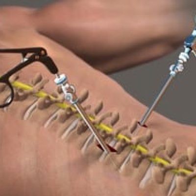 اندوسکوپیک دیسککتومی