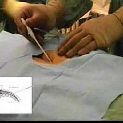 اپیدوروسکوپی لیزری دیسک