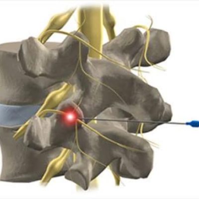 تزریق های ستون فقرات