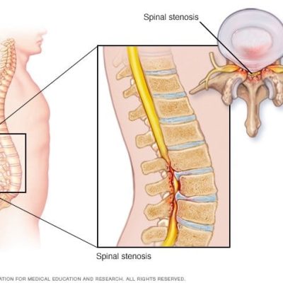 تنگی کانال نخاعی