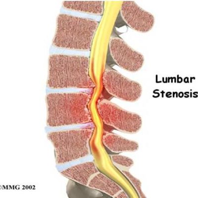 تنگی کانال نخاعی
