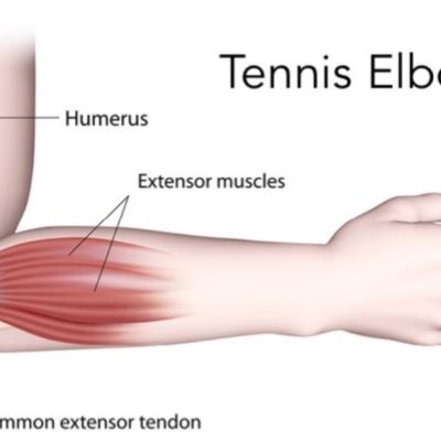 تنیس البو چیست