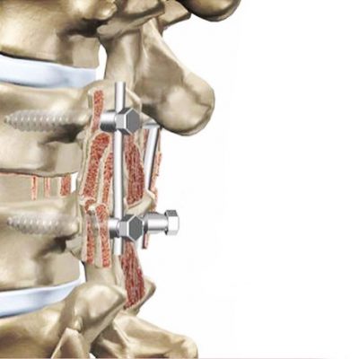حان وقت الجراحة المفتوحة لعلاج تضيق القناة الشوكية