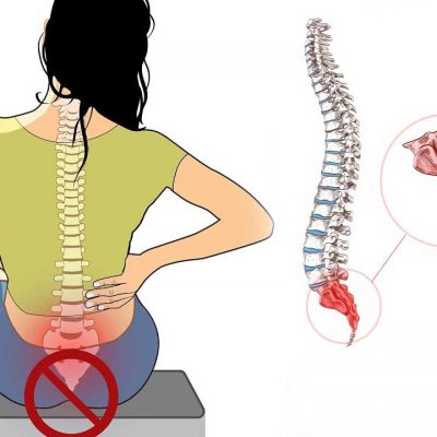 درد دنبالچه یا COCCYDYNIA