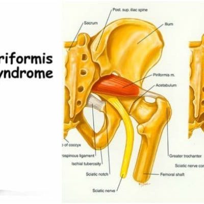 سندروم پیریفورمیس و درمان آن