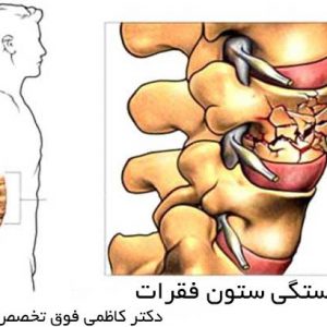 شکستگی ستون فقرات
