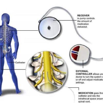 پمپ های داخل نخاعی