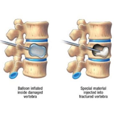 کایفوپلاستی
