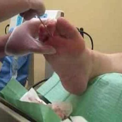 کرایو درمانی